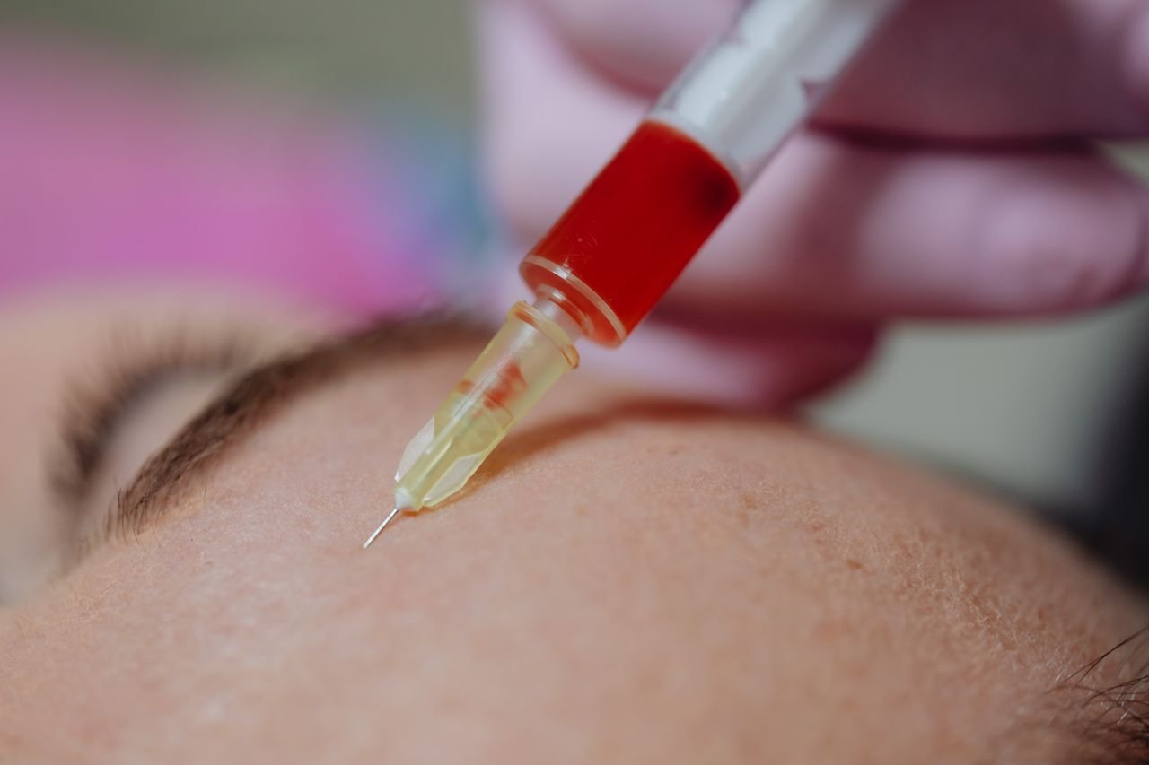 PRP Therapy for Hair Restoration at Facethetics Beauty